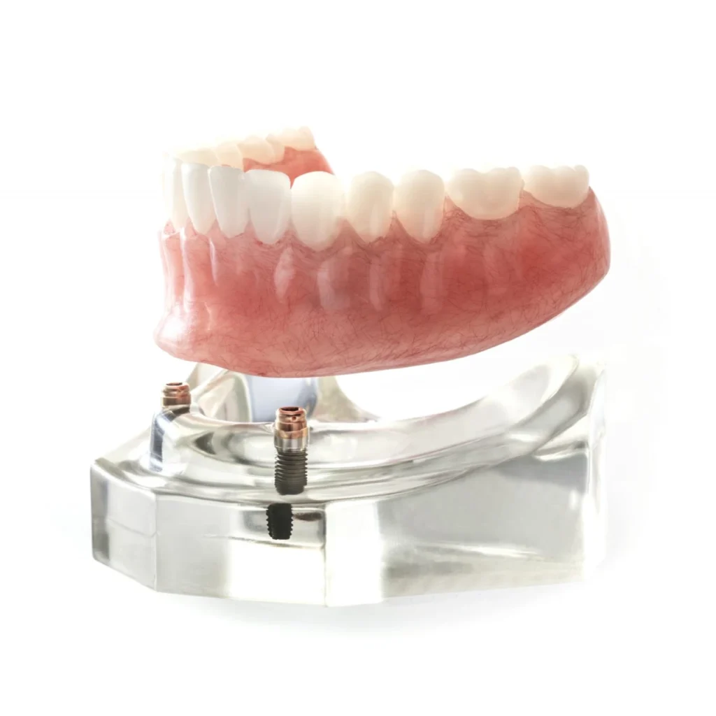 2-implant lower snap-in implant denture
