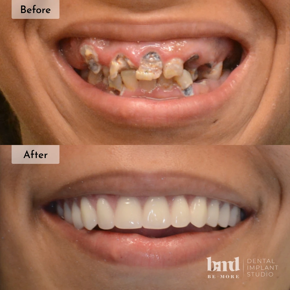 Before and after dental implants in Baltimore at Be More Dental Implant Studio