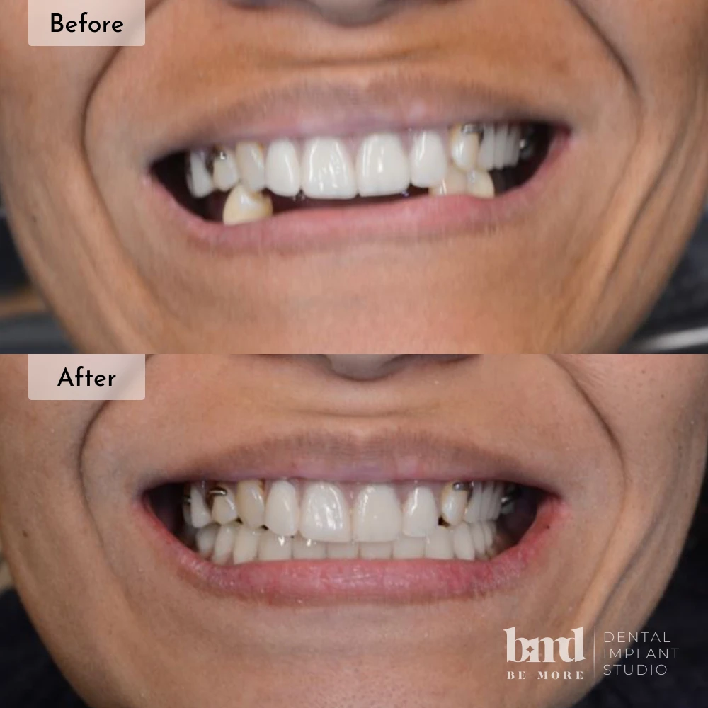 Before and after dental implants in Baltimore at Be More Dental Implant Studio