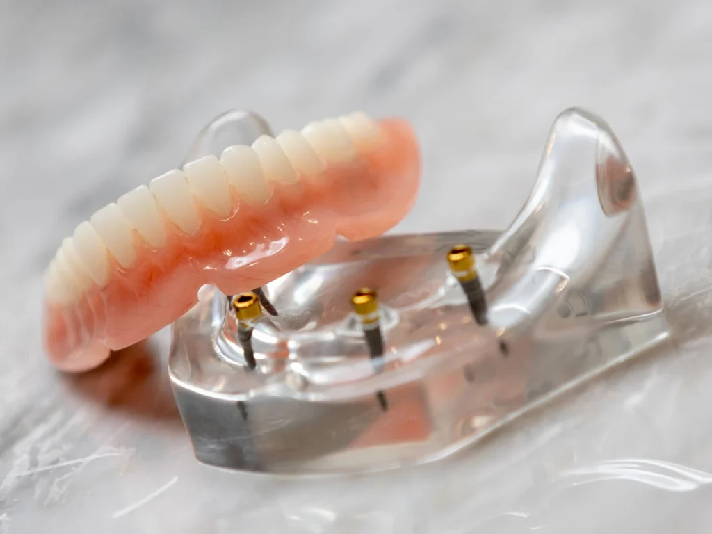4-implant lower snap-in implant denture unsnapped